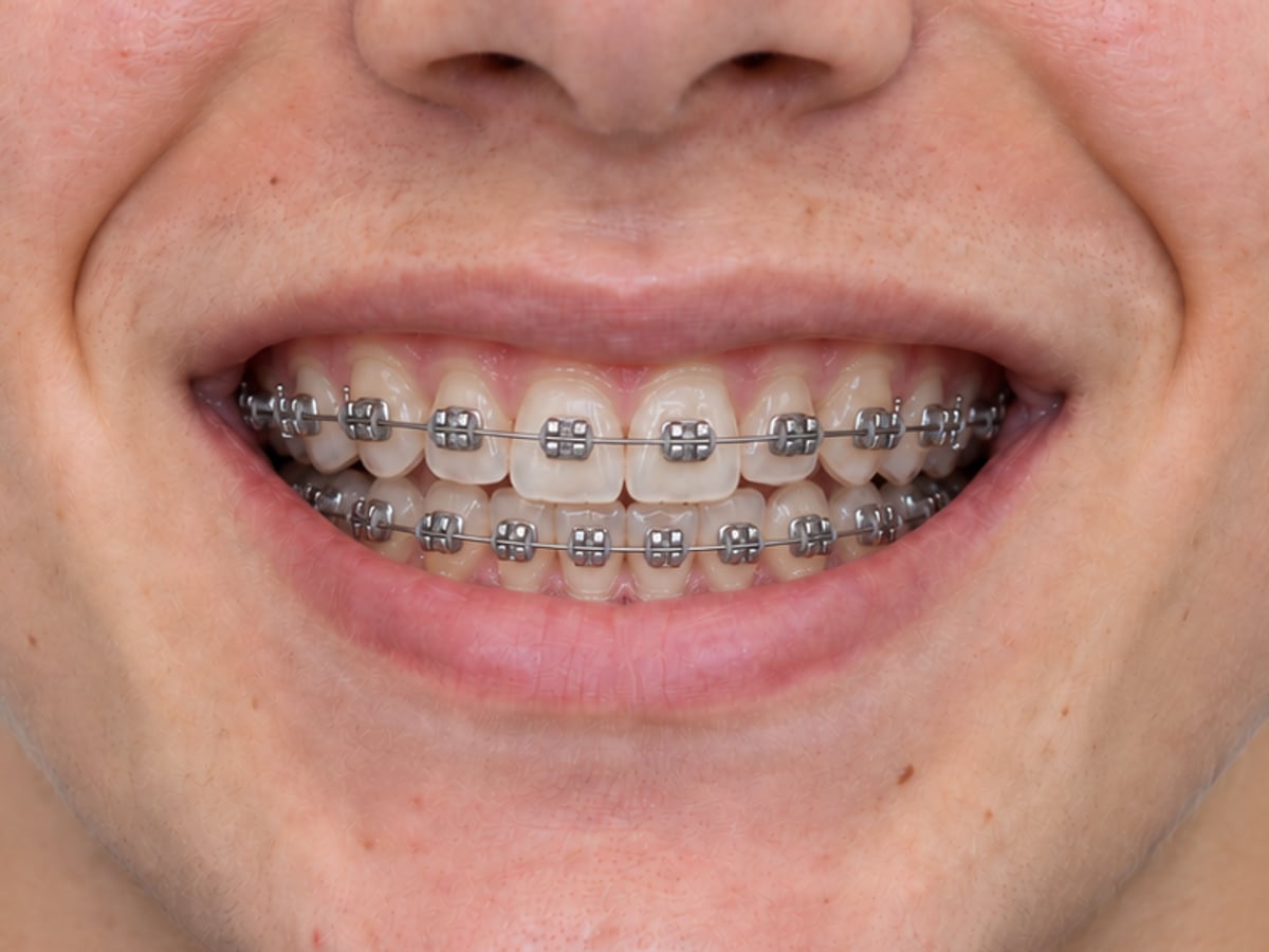 After orthodontic braces