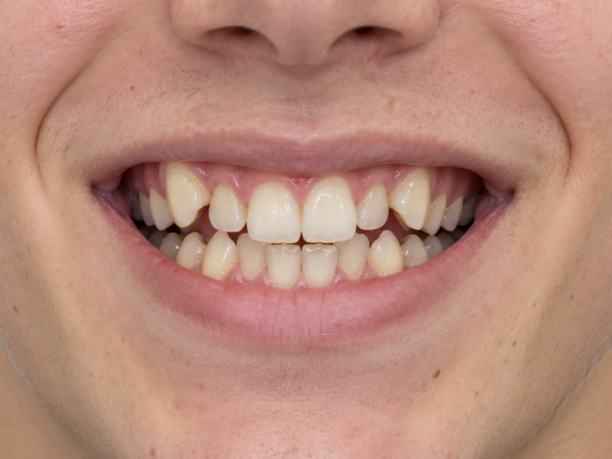 Before orthodontic braces